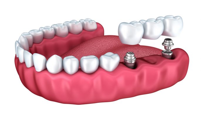 picture of dental implants