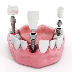picture of partial dental implants